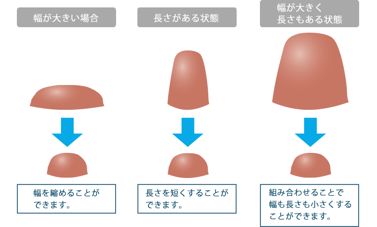 オリジナル切開法で、直径と高さを自由にオーダーメイド