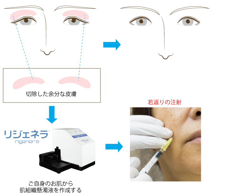 たるみ治療で切除した皮膚による注入