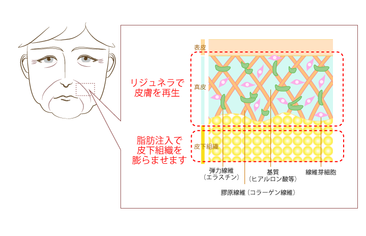 脂肪注入との組み合わせ法