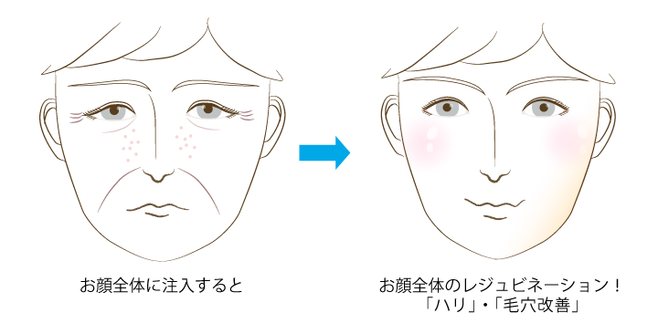 リジェネラ水光でお顔全体に注入すると