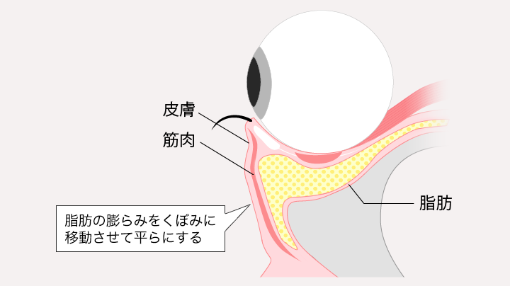 脂肪移動術の原理