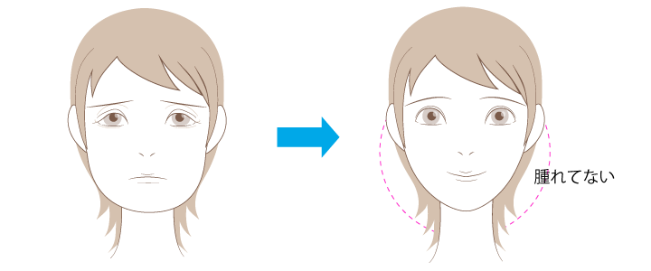 「腫れない」手術方法