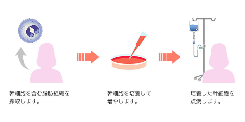 幹細胞を含む脂肪組織を採取します。→幹細胞を培養して増やします。→培養した幹細胞を点滴します。