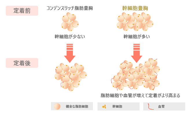 コンデンスリッチ脂肪豊胸（幹細胞が少ない）、幹細胞豊胸（幹細胞が多い・脂肪細胞や血管が増えて定着がより高まる）