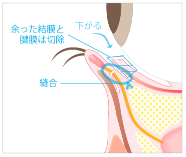 垂れ目形成術