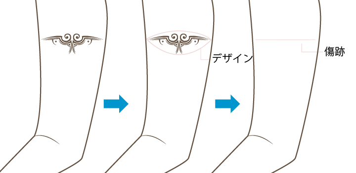 切除縫合法（手術）