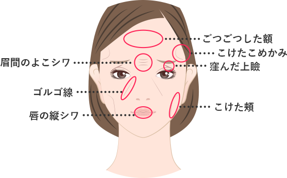 その他ヒアルロン酸を注入できる部位