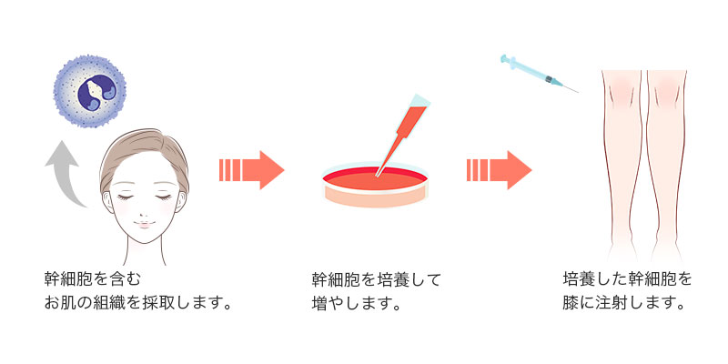 幹細胞を含む脂肪組織を採取します。→幹細胞を培養して増やします。→培養した幹細胞を点滴します。