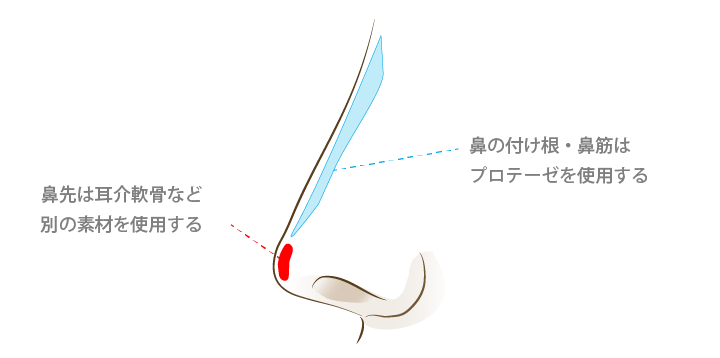 鼻シリコンプロテーゼ