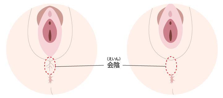 会陰部贅皮切除術 美容外科 皮膚科 婦人科形成のルーチェクリニック