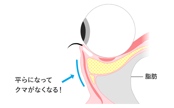 ふくらんだ脂肪を取って、凹んだ部分に脂肪を注入して凹凸をなくします。