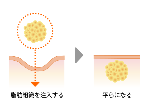 従来の切開部分