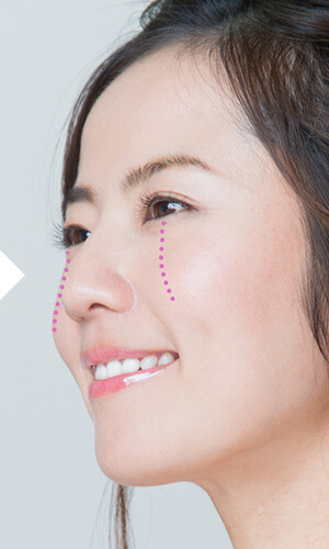 目の下から頬にかけてのライン