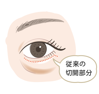 従来の切開部分