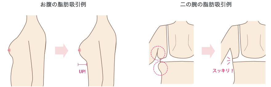脂肪吸引イラスト