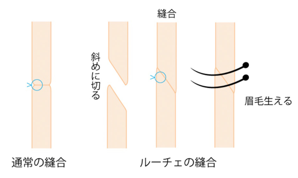施術イメージ