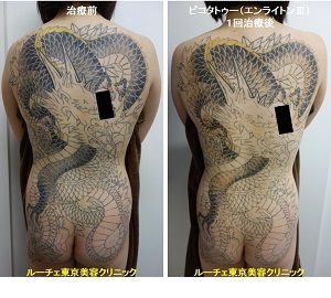 タトゥー除去ピコレーザー、背中～臀部、黒、黄色、赤