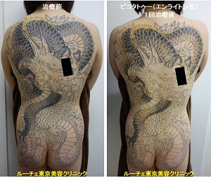 タトゥー除去ピコレーザー、1回、背中～臀部、黒、黄色、赤