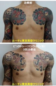 タトゥー除去ピコレーザー、腕～胸、黒、赤