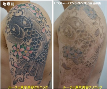 タトゥー除去ピコレーザー、6回、腕、黒、緑、ピンク、黄色