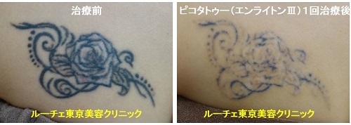 タトゥー除去ピコレーザー、1回、胸、黒、赤