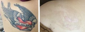 タトゥー除去ピコレーザー症例④ルーチェクリニック