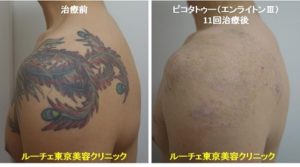 タトゥー除去ピコレーザー肩、黒、赤、緑、紫、黄色