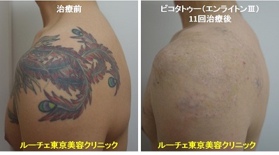 タトゥー除去ピコレーザー、11回、肩、黒、赤、緑、紫、黄色