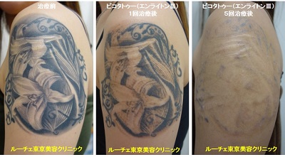 タトゥー除去ピコレーザー、5回、腕、黒