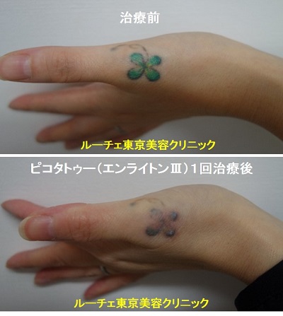 タトゥー除去ピコレーザー、1回、手、黒、緑、黄色