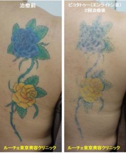 タトゥー除去ピコレーザー、背中、青、水色、緑、黄緑、黄色、オレンジ、黒