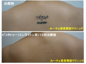 タトゥー除去ピコレーザー 12回 背中 黒 ピコレーザーラボ 美容外科 皮膚科 婦人科形成のルーチェクリニック