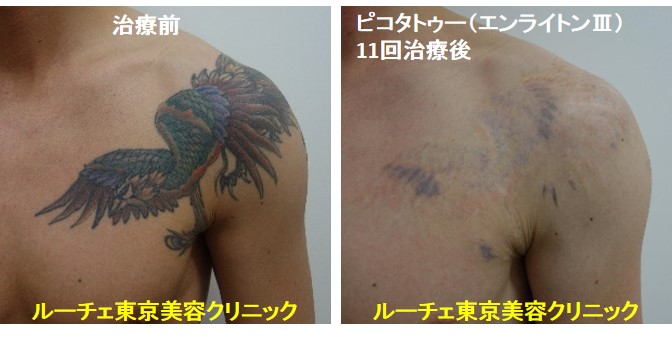 タトゥー除去ピコレーザー、11回、胸、黒、緑、青、赤、オレンジ
