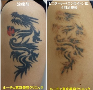 タトゥー除去ピコレーザー、4回、腕、黒、赤