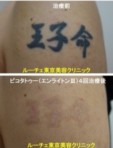 タトゥー除去ピコレーザー、4回、腕、黒