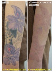 タトゥー除去ピコレーザー、10回、腕、黒、赤、紫