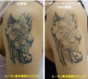 タトゥー除去ピコレーザー、1回、腕、黒、緑