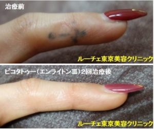 タトゥー除去ピコレーザー、指、黒