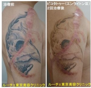 タトゥー除去ピコレーザー、2回、腕、黒