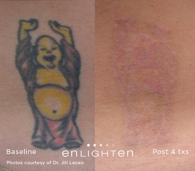 ピコレーザー（エンライトン）でのタトゥー除去症例