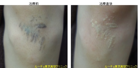 膝の外傷性タトゥー除去