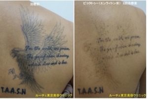 背中のぼかしタトゥー1回黒 ピコレーザーラボ 美容外科 皮膚科 婦人科形成のルーチェクリニック