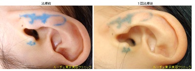 青と赤の耳タトゥー