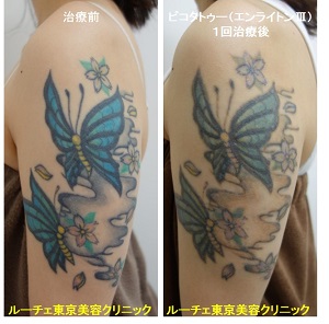腕のカラフルな蝶々とお花のタトゥーを薄くしていきます。１回腕黒青水色黄緑緑