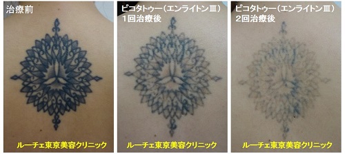 背中の黒く丸い形のタトゥーが薄くなっていく過程の経過写真　2回背中黒