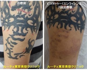 腕の黒い竜のタトゥーを半袖から出る部分だけ消します 7回腕黒赤 ピコレーザーラボ