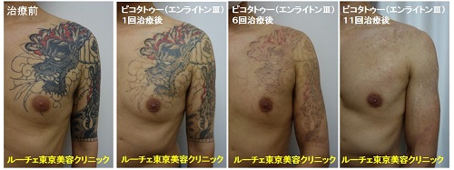 胸から腕にかけて広がる龍のカラフルタトゥー 11回　腕　肩　胸　黒　赤