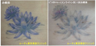 腰の黒と紫の花のタトゥーのインクを取っています。1回　腰　紫