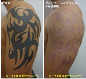 腕のべったり濃いインクのタトゥーを消していきます 9回腕黒 ピコレーザーラボ