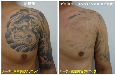 胸から腕のサルの黒いタトゥーを消しています 3回 黒 腕 肩 胸 ピコレーザーラボ